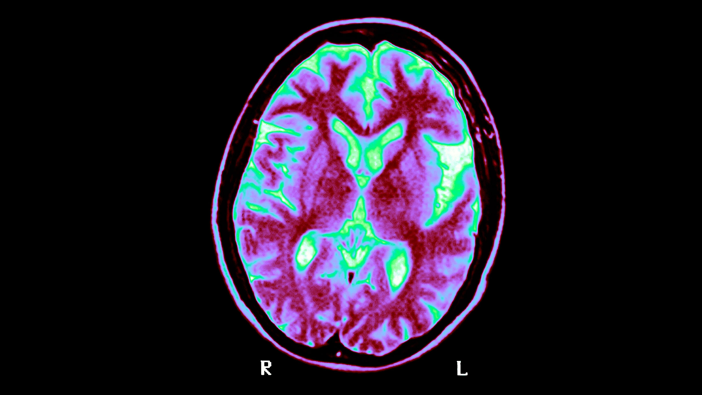 Image from a brain scan. Photo: BSIP/Getty Images